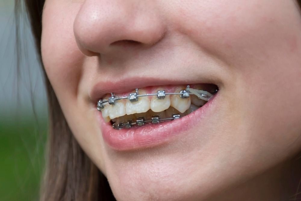 Close-up of a smiling patient showing metal braces on teeth – braces for overbite in Chester Springs, PA.