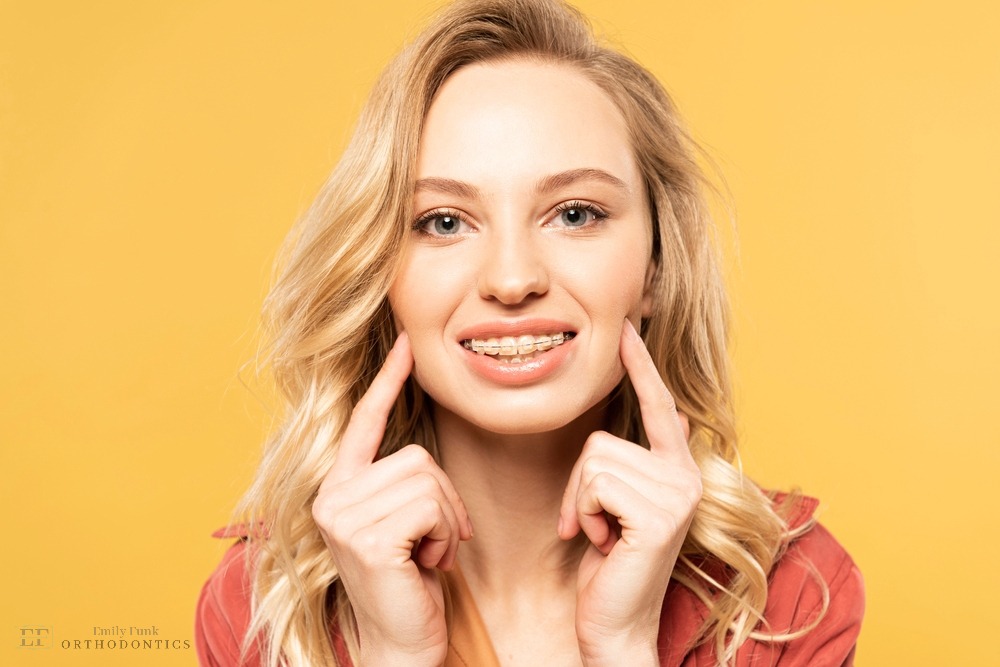 smiling blonde woman clear braces looking camera - Overbite vs underbite in Chester Springs, PA.